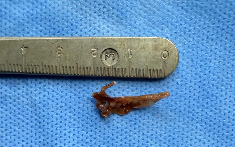 Fish Bone trapped in lung for over a year successfully removed at VPS Lakeshore Hospital